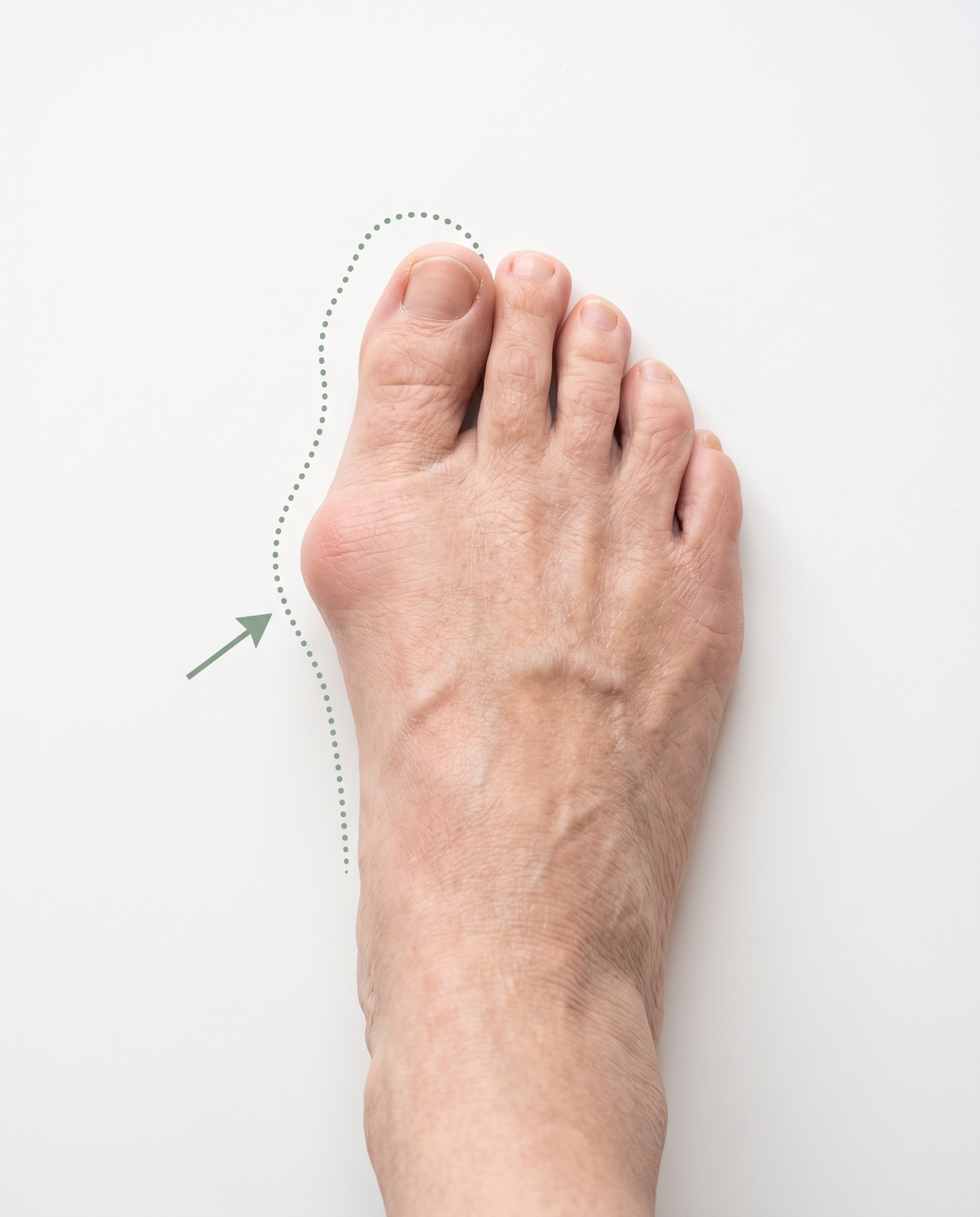 A bunion foot from above with a dotted line where the big toe should sit straight