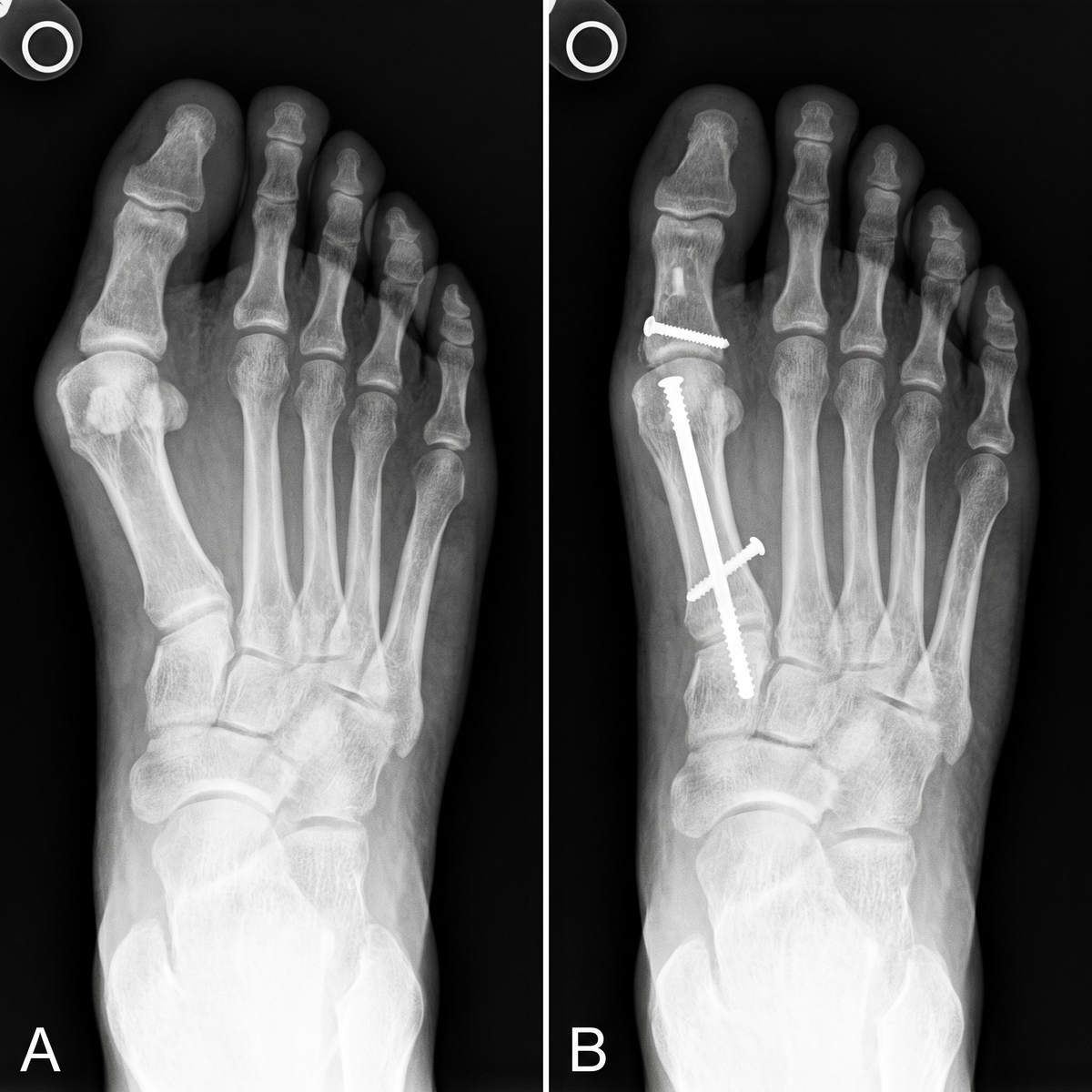 Bunion surgery X-ray before and after with screws